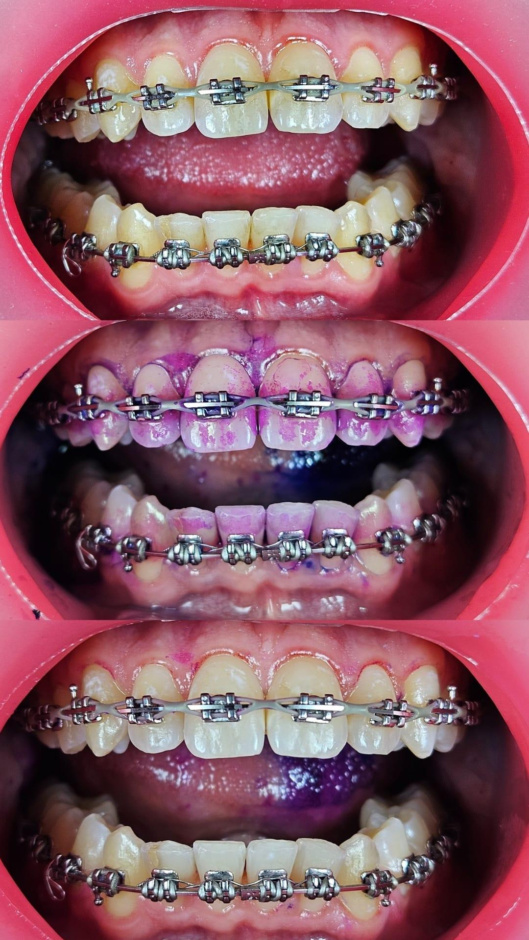Wangen- & Lippenretraktion in der Zahnmedizin: Techniken, Werkzeuge & Best Practices