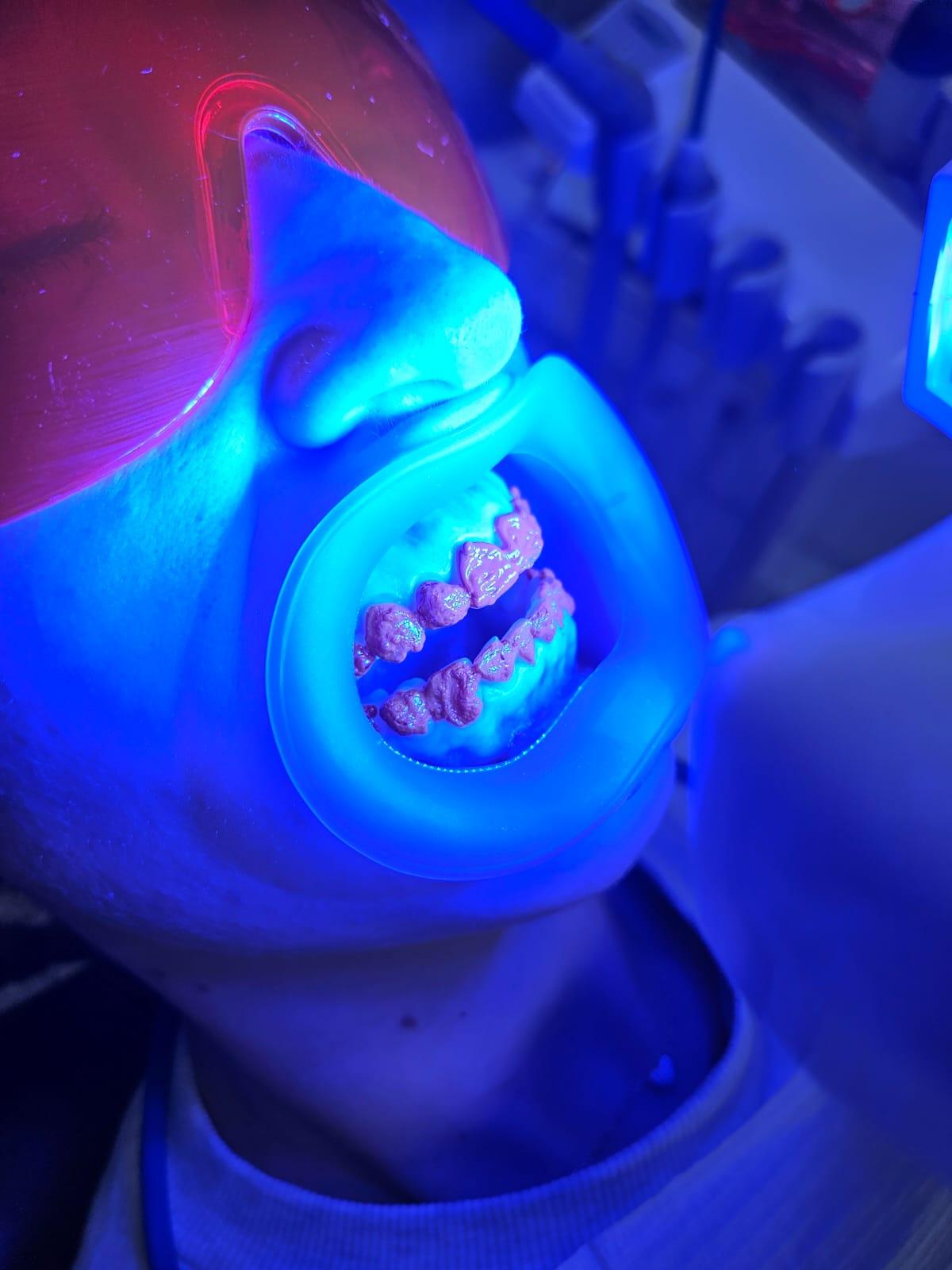 Bester Lippen- & Wangenhalter für das Bleaching (Kaufberatung)